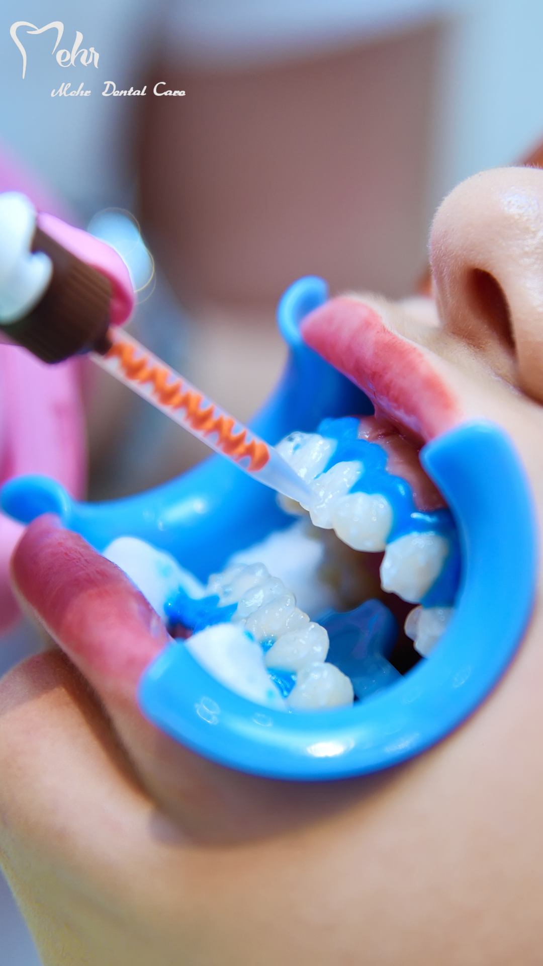 نمونه کار بلیچینگ 1