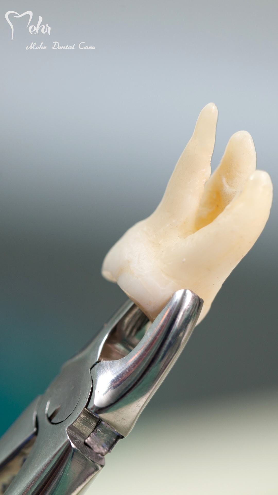 کاور ویدیو کشیدن دندان عقل