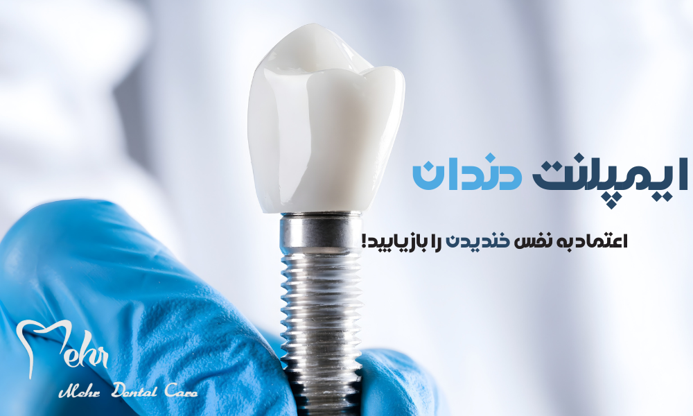 استفاده از بهترین برندهای ایمپلنت