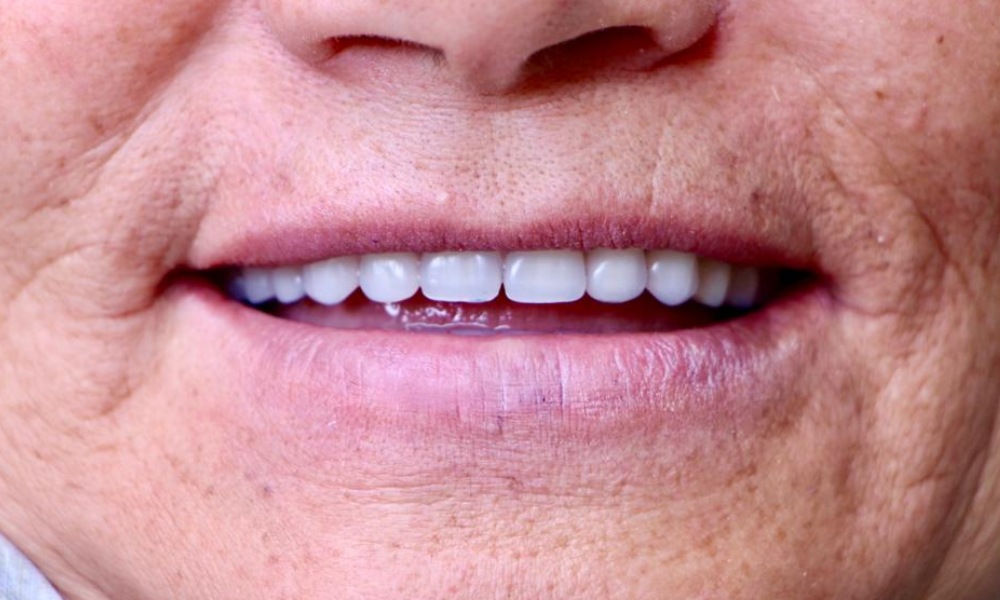 بعد از ایمپلنت