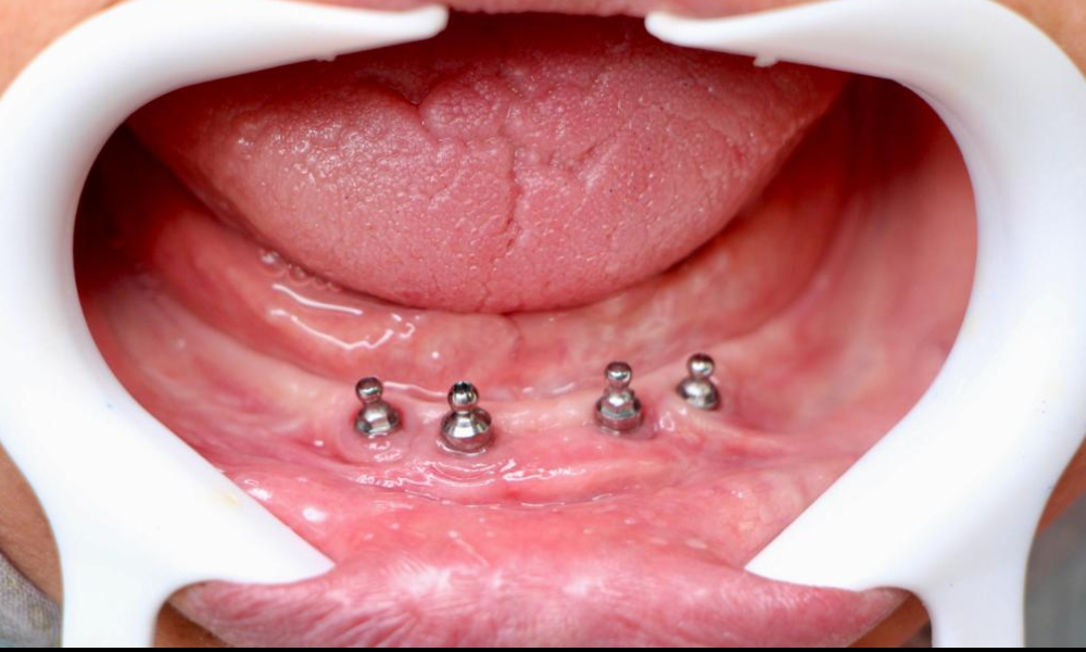 قبل از ایمپلنت